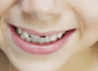 Teeth Whitening Sarnia