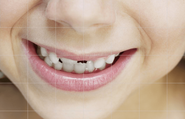 Teeth Whitening Sarnia